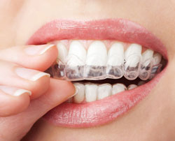 clear teeth aligners in mouth, Nottingham, MD Invisalign treatment